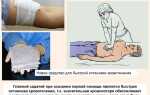 Как быстрее всего остановить сильное кровотечение пдд