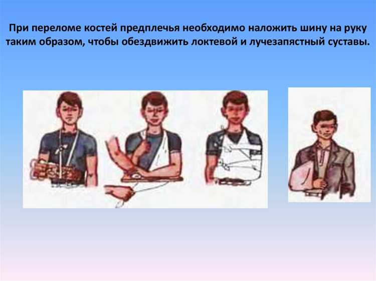Первая помощь при переломах: правила и действия на дороге