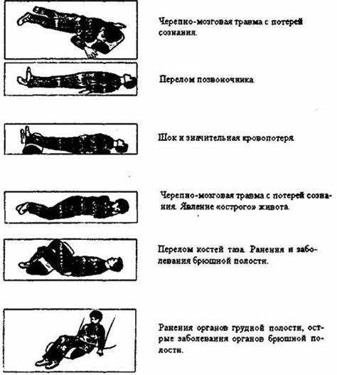 Когда и почему применяется поза лягушки при травме таза