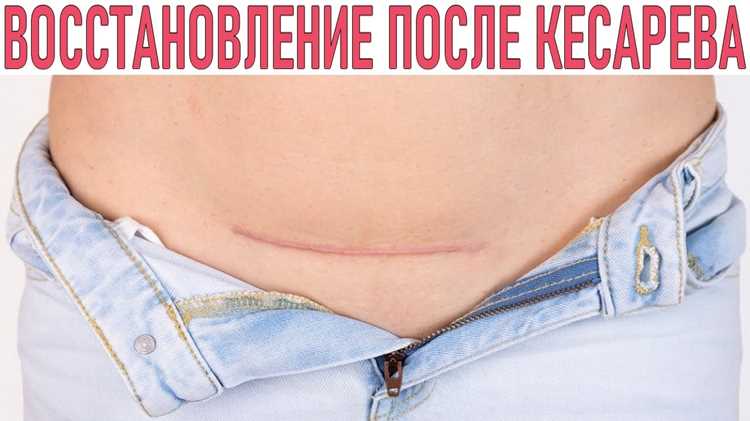 Когда можно ездить на велосипеде после кесарева сечения